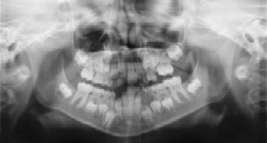 Dental Radiographs (X-Rays) - Pediatric Dentistry and Orthodontics in Corpus Christi, TX