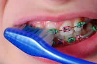 Braces Care - Orthodontics in Corpus Christi, TX