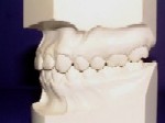 Class I - Malocclusion - Orthodontics in Corpus Christi, TX