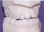 Crossbite - Occlusion - Orthodontics in Corpus Christi, TX