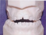 Openbite - Occlusion - Orthodontics in Corpus Christi, TX