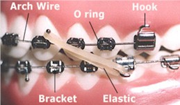 Orthodontic Terms - Orthodontics in Corpus Christi, TX