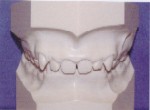 Overbite - Occlusion - Orthodontics in Corpus Christi, TX