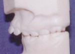 Overjet - Occlusion - Orthodontics in Corpus Christi, TX