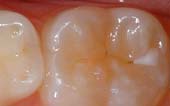 Sealant-Before - Pediatric Dentistry and Orthodontics in Corpus Christi, TX